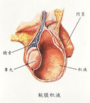 鞘膜积液